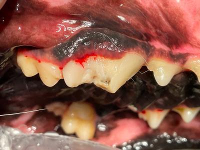 歯肉の中まで割れ目が入っていて破折片も既に失われています。歯髄（神経）が見えている部分も変色しています。（健康な歯髄はピンク色です。）
