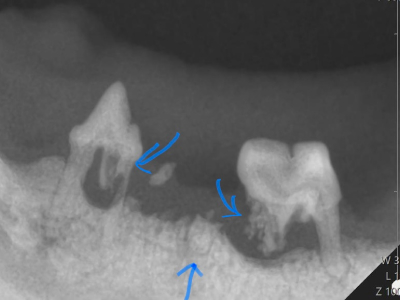 X線で確認すると両隣の歯も溶けてきています。痛みの原因になるので全部抜歯となりました。
