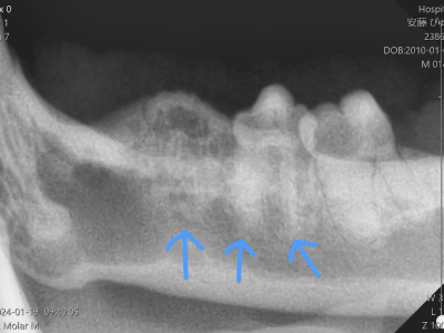 X線では歯の密度が低くなり、一部は溶けてなくなっています。もろくなって歯が折れると痛みの原因になることがあります。