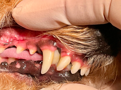 下顎が短く、下の犬歯は正しい上顎の隙間に入り込むことが出来ず、上顎に刺さっています。下の犬歯を短く切って被せ物をつける歯冠短縮術を行うと上顎が傷つかなくなります。