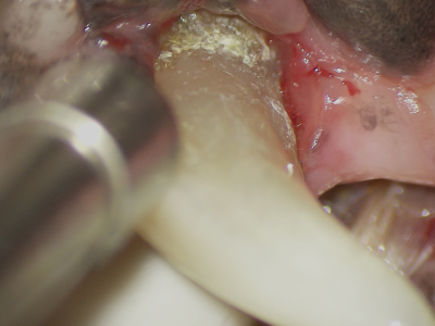 マイクロスコープを用いて拡大してみると深い歯周ポケットの中は歯石だらけです。