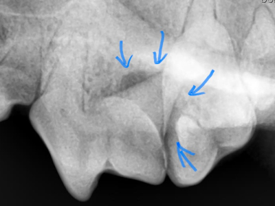 X線で確認するとやはり根っこの周りの骨が歯周病によりなくなっています。