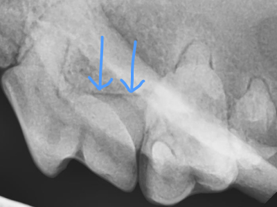 5ヶ月後のX線で骨が再生してきているのが確認できます。これで大事な噛む時に必要な歯を維持できます。