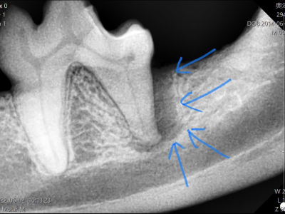 X線を撮ってみると歯の後ろ側の骨が歯周病によりなくなっています。