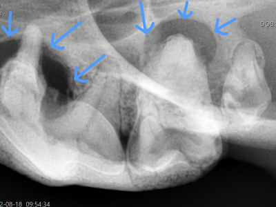 X線では上顎の骨が溶けてなくなっています。感染源を取り除き顎の骨を守るために上顎全抜歯となりました。