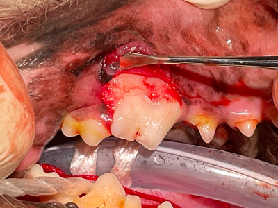 歯肉の中まで割れているので、歯肉を剥離し、歯の断面と破折片をきれいに整えた後接着します。（破折片は再利用できる場合と出来ない場合があります。）