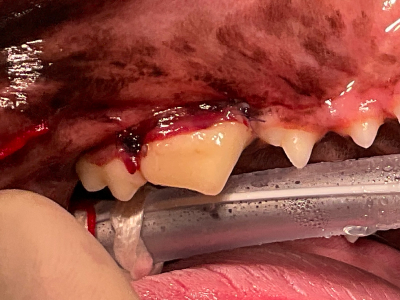 なくなってしまった先端部分を作り直し、歯肉を戻して縫合しています。