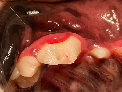 歯肉縁下（歯肉の中）まで破折し、神経も露出しています。