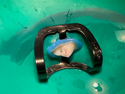 ラバーダムを装着し、歯髄保護を実施します。