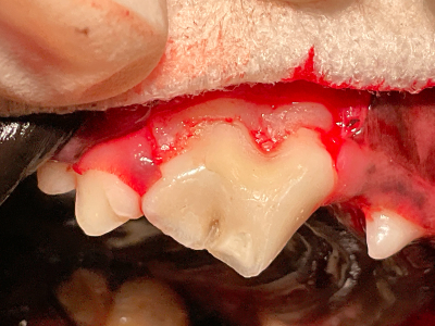 歯肉を切開・剥離してから全体を修復します。