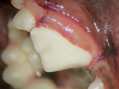 歯肉を戻し縫合しました。