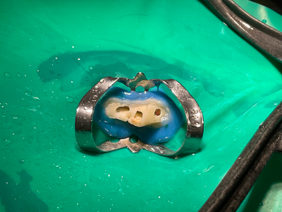 ラバーダム防湿を施します。口内の湿気を遮断し、また生体に有毒な洗浄液の漏出防止にもとても重要です。