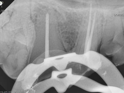 治療中は何度もX線撮影し、歯内の状況を確認しながら治療を進めます。