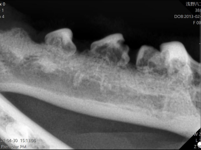 X線を撮ってみると、歯根は著しく変質し骨との境目が分からなくなっています。