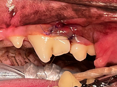 歯肉を縫合して元に戻し治療終了。