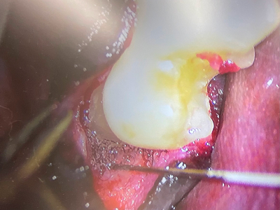 オープンフラップデブライドメントを実施し、特殊なお薬を塗布し閉じ込めます。