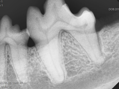 1年後のX線では見事に骨が再生しています。